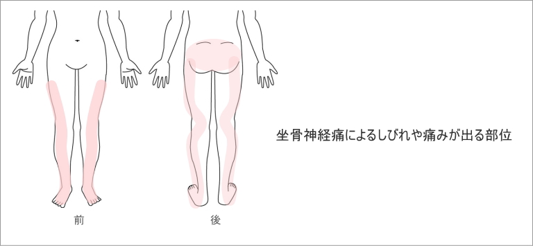 坐骨神経痛の現れる場所