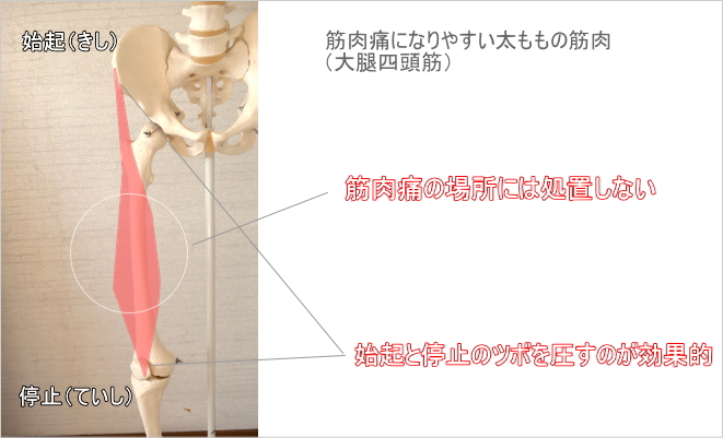 ふくらはぎの筋肉痛への処置のコツ